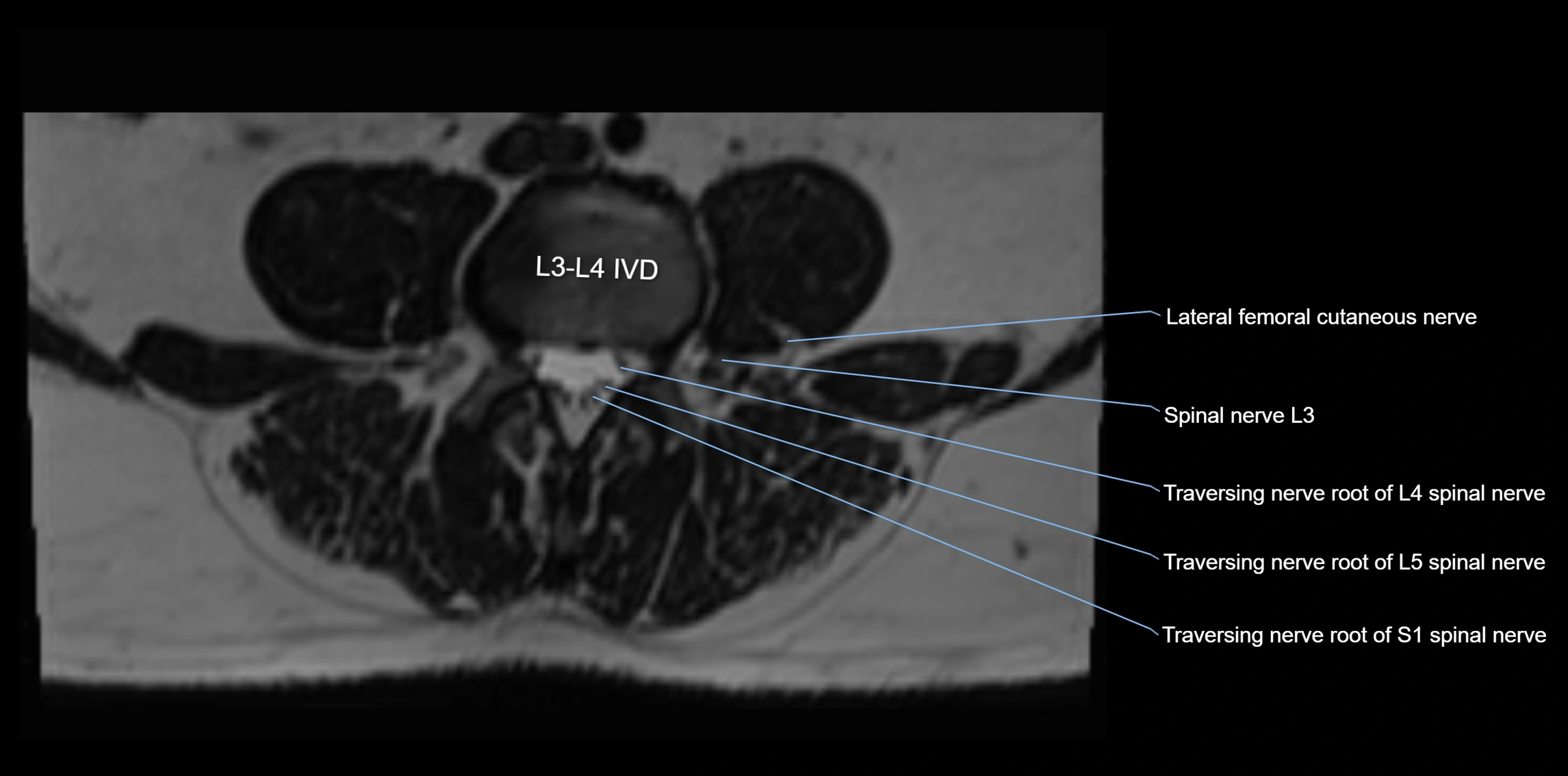 MR lumbosacral plexus axial cross sectional anatomy 3T  radiology  image-img-1008001-00034.webp
